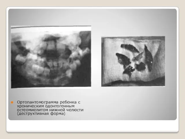 Ортопантомограмма ребенка с хроническим одонтогенным остеомиели­том нижней челюсти (деструктивная форма)