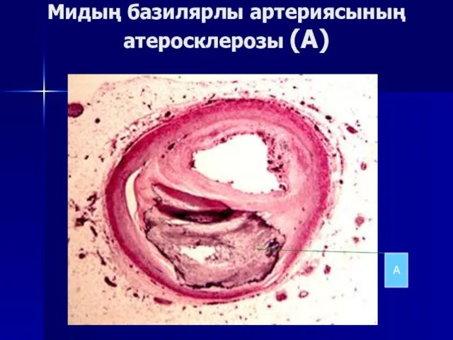 Мидың базилярлы артериясының атеросклерозы (А) А