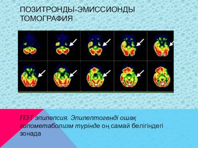 ПОЗИТРОНДЫ-ЭМИССИОНДЫ ТОМОГРАФИЯ ПЭТ эпилепсия. Эпилептогенді ошақ гипометаболизм түрінде оң самай бөлігіндегі зонада