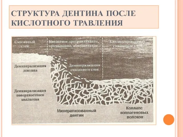 СТРУКТУРА ДЕНТИНА ПОСЛЕ КИСЛОТНОГО ТРАВЛЕНИЯ