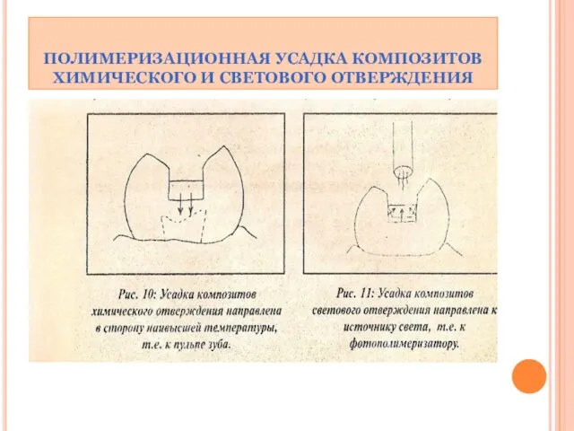 ПОЛИМЕРИЗАЦИОННАЯ УСАДКА КОМПОЗИТОВ ХИМИЧЕСКОГО И СВЕТОВОГО ОТВЕРЖДЕНИЯ