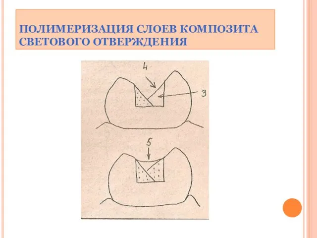 ПОЛИМЕРИЗАЦИЯ СЛОЕВ КОМПОЗИТА СВЕТОВОГО ОТВЕРЖДЕНИЯ