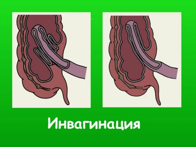 Схематическое изображение инвагинации тонкой кишки в слепую — двойная инвагинация