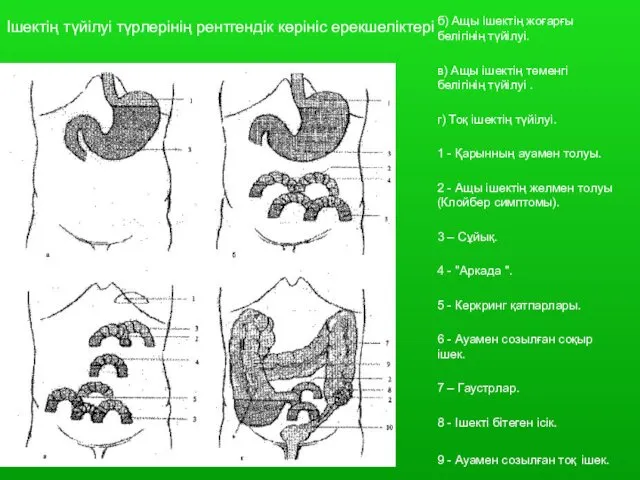 Ішектің түйілуі түрлерінің рентгендік көрініс ерекшеліктері а) Он екі елі