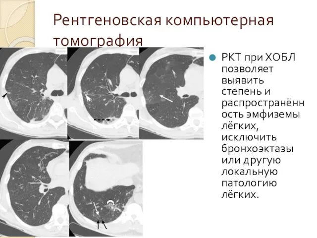 Рентгеновская компьютерная томография РКТ при ХОБЛ позволяет выявить степень и