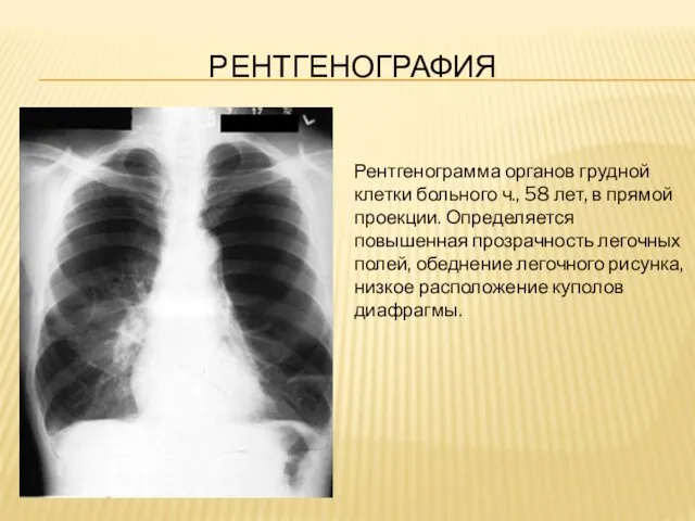 РЕНТГЕНОГРАФИЯ Рентгенограмма органов грудной клетки больного ч., 58 лет, в