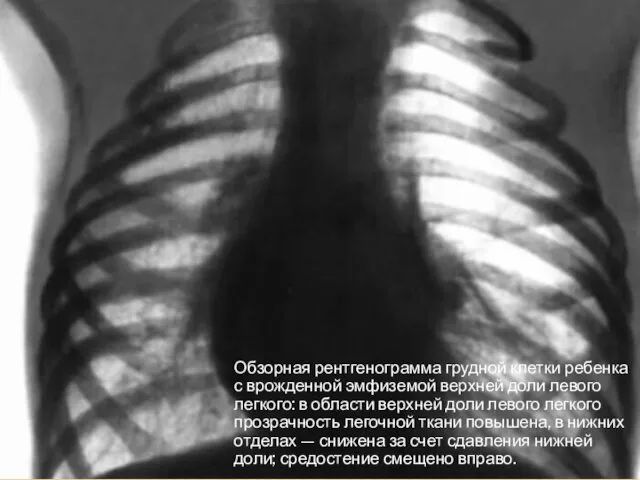 Обзорная рентгенограмма грудной клетки ребенка с врожденной эмфиземой верхней доли