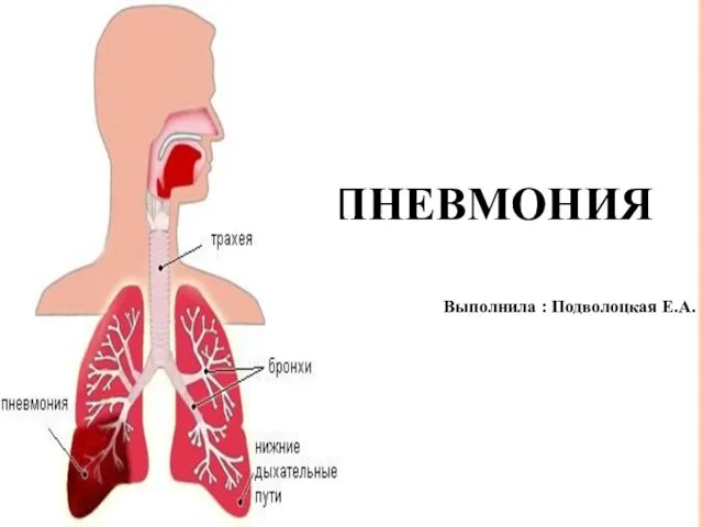 ПНЕВМОНИЯ Выполнила : Подволоцкая Е.А.