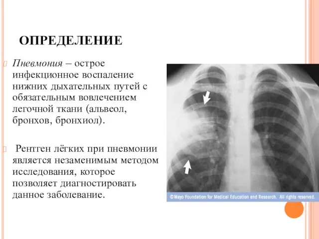 ОПРЕДЕЛЕНИЕ Пневмония – острое инфекционное воспаление нижних дыхательных путей с