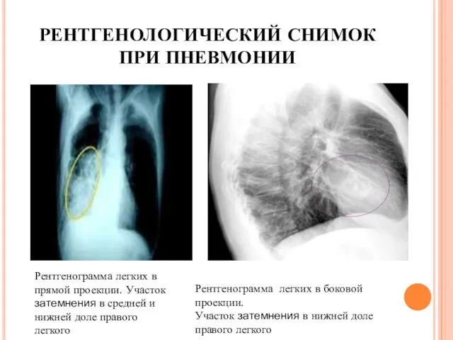 РЕНТГЕНОЛОГИЧЕСКИЙ СНИМОК ПРИ ПНЕВМОНИИ Рентгенограмма легких в прямой проекции. Участок