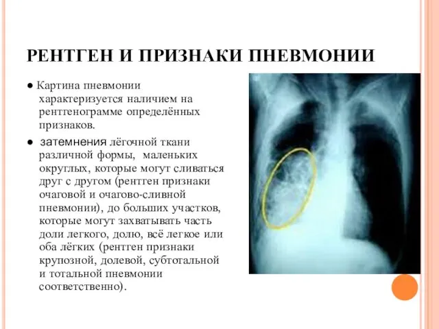 РЕНТГЕН И ПРИЗНАКИ ПНЕВМОНИИ ● Картина пневмонии характеризуется наличием на