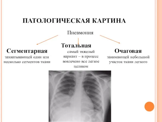 ПАТОЛОГИЧЕСКАЯ КАРТИНА Пневмония Сегментарная захватывающей один или несколько сегментов ткани