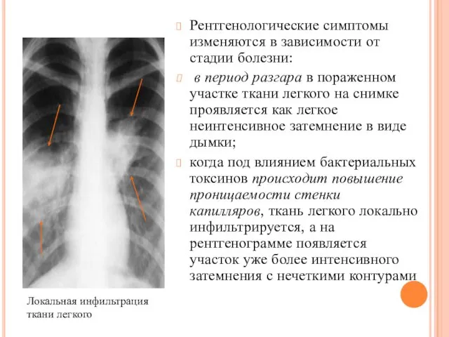 Рентгенологические симптомы изменяются в зависимости от стадии болезни: в период