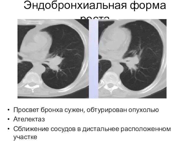 Эндобронхиальная форма роста Просвет бронха сужен, обтурирован опухолью Ателектаз Сближение сосудов в дистальнее расположенном участке