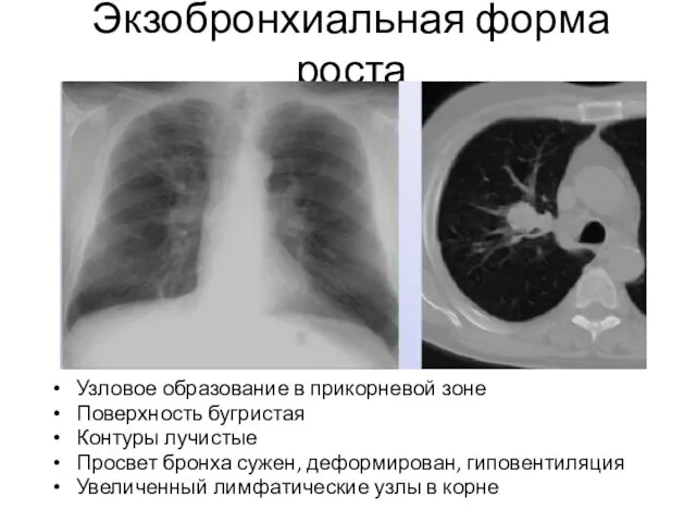 Экзобронхиальная форма роста Узловое образование в прикорневой зоне Поверхность бугристая