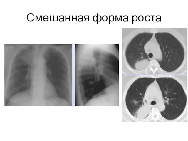 Смешанная форма роста