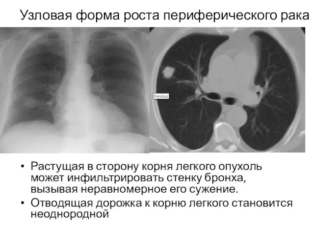 Узловая форма роста периферического рака Растущая в сторону корня легкого