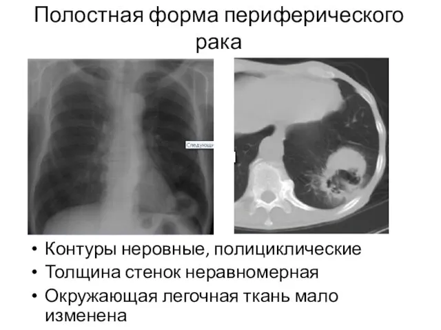 Полостная форма периферического рака Контуры неровные, полициклические Толщина стенок неравномерная Окружающая легочная ткань мало изменена