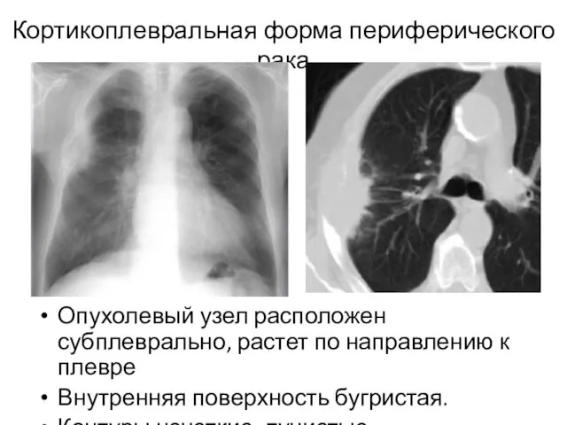 Кортикоплевральная форма периферического рака Опухолевый узел расположен субплеврально, растет по