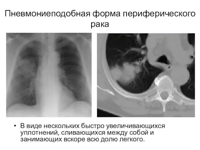 Пневмониеподобная форма периферического рака В виде нескольких быстро увеличивающихся уплотнений,