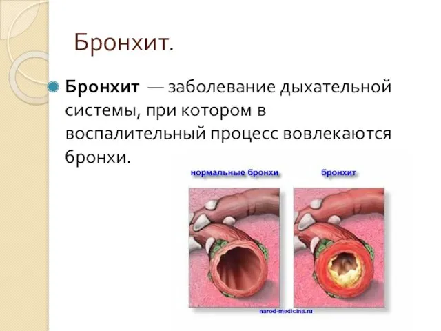 Бронхит. Бронхит — заболевание дыхательной системы, при котором в воспалительный процесс вовлекаются бронхи.