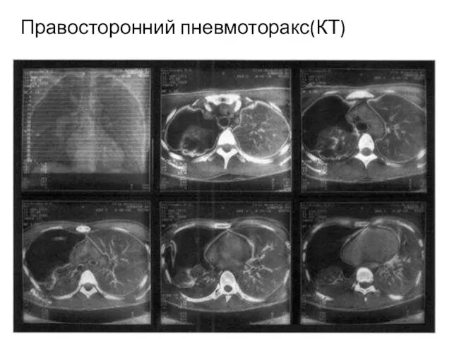 Правосторонний пневмоторакс(КТ)