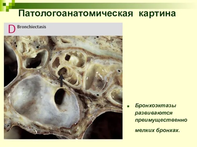 Патологоанатомическая картина Бронхоэктазы развиваются преимущественно мелких бронхах.