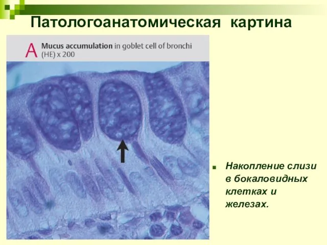 Накопление слизи в бокаловидных клетках и железах. Патологоанатомическая картина