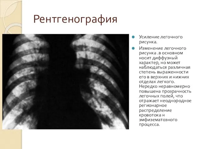 Рентгенография Усиление легочного рисунка. Изменение легочного рисунка .в основном носит