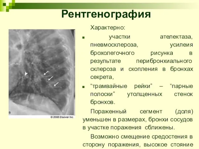 Характерно: участки ателектаза, пневмосклероза, усилеия брохолегочного рисунка в результате перибронхиального