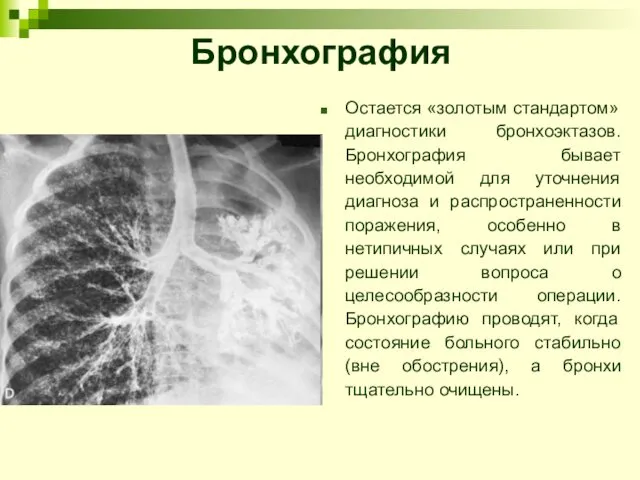 Бронхография Остается «золотым стандартом» диагностики бронхоэктазов. Бронхография бывает необходимой для