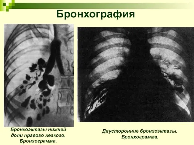 Бронхография Бронхоэктазы нижней доли правого легкого. Бронхограмма. Двусторонние бронхоэктазы. Бронхограмма.