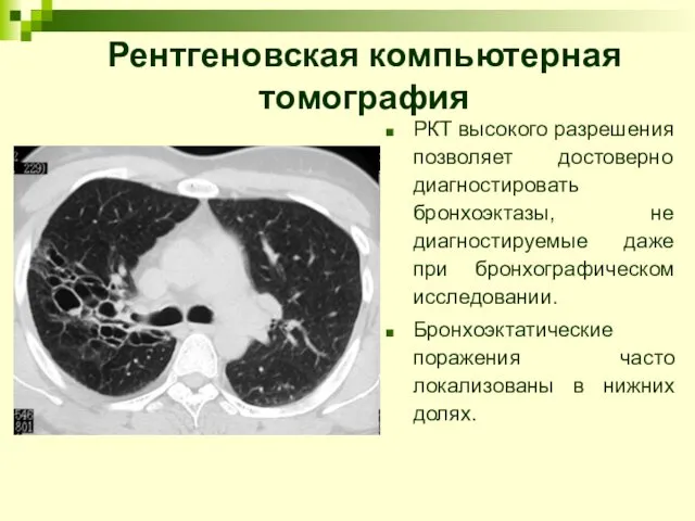 Рентгеновская компьютерная томография РКТ высокого разрешения позволяет достоверно диагностировать бронхоэктазы,