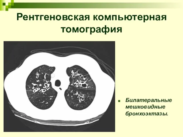 Билатеральные мешковидные бронхоэктазы. Рентгеновская компьютерная томография