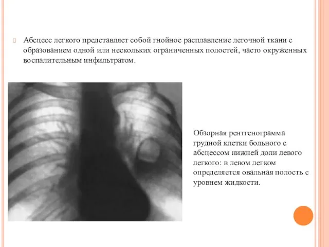 Абсцесс легкого представляет собой гнойное расплавление легочной ткани с образованием