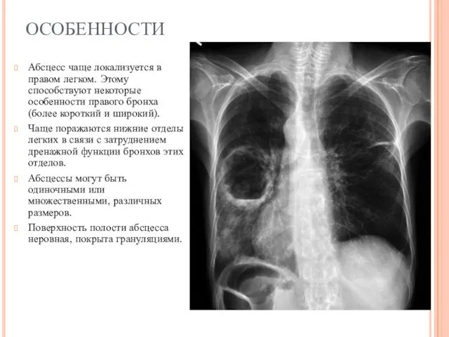 ОСОБЕННОСТИ Абсцесс чаще локализуется в правом легком. Этому способствуют некоторые