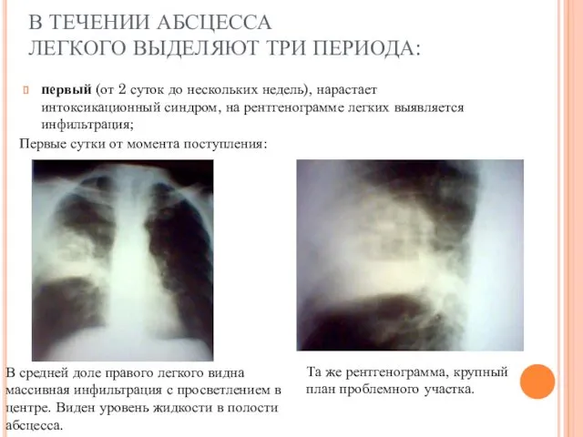 В ТЕЧЕНИИ АБСЦЕССА ЛЕГКОГО ВЫДЕЛЯЮТ ТРИ ПЕРИОДА: первый (от 2