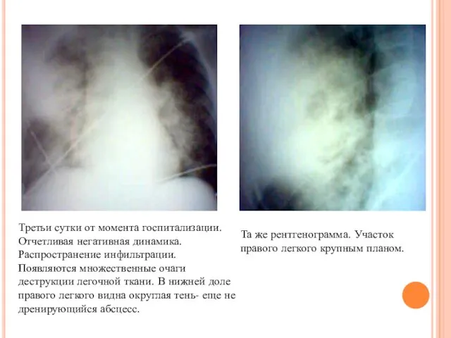 Третьи сутки от момента госпитализации. Отчетливая негативная динамика. Распространение инфильтрации.