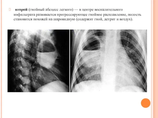 второй (гнойный абсцесс легкого) — в центре воспалительного инфильтрата развивается