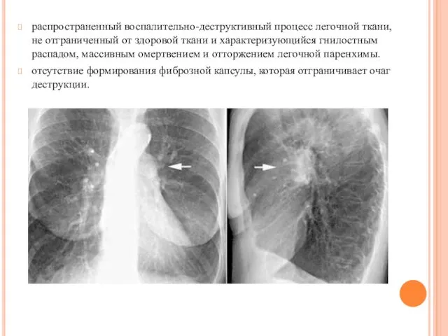 распространенный воспалительно-деструктивный процесс легочной ткани, не отграниченный от здоровой ткани