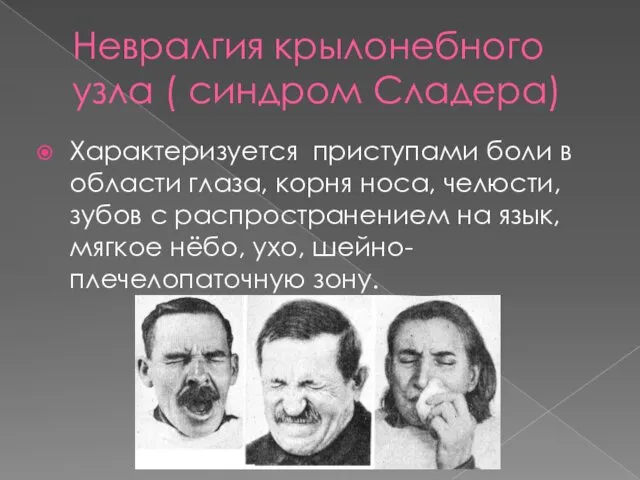 Невралгия крылонебного узла ( синдром Сладера) Характеризуется приступами боли в