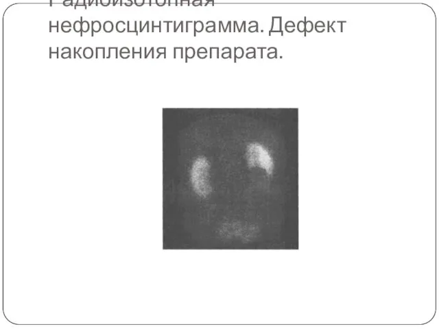 Радиоизотопная нефросцинтиграмма. Дефект накопления препарата.