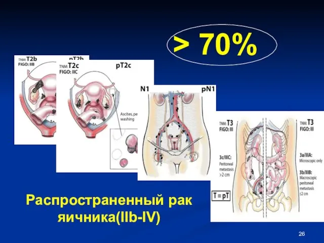 Распространенный рак яичника(IIb-IV) > 70%