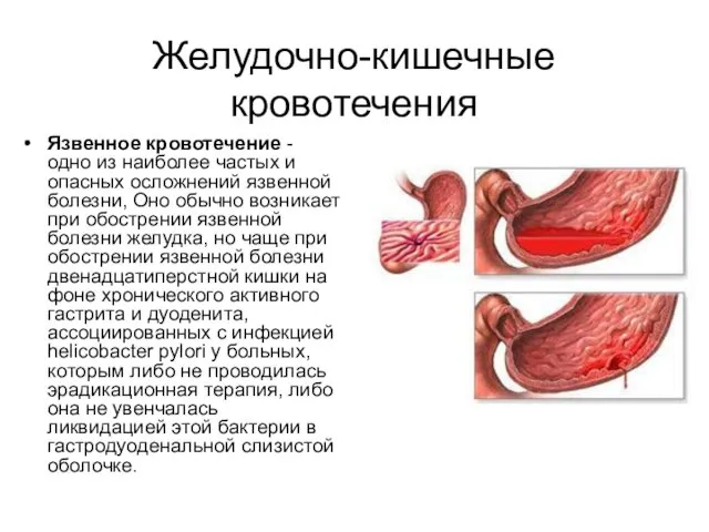 Желудочно-кишечные кровотечения Язвенное кровотечение - одно из наиболее частых и