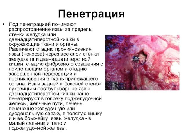 Пенетрация Под пенетрацией понимают распространение язвы за пределы стенки желудка