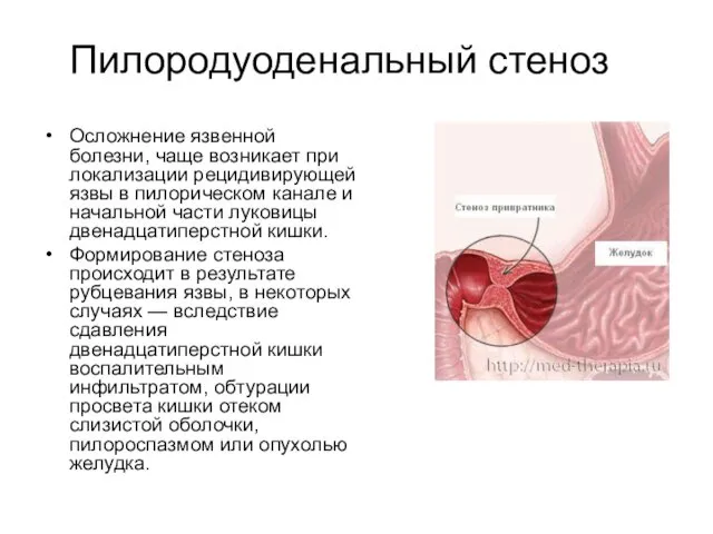 Пилородуоденальный стеноз Осложнение язвенной болезни, чаще возникает при локализации рецидивирующей