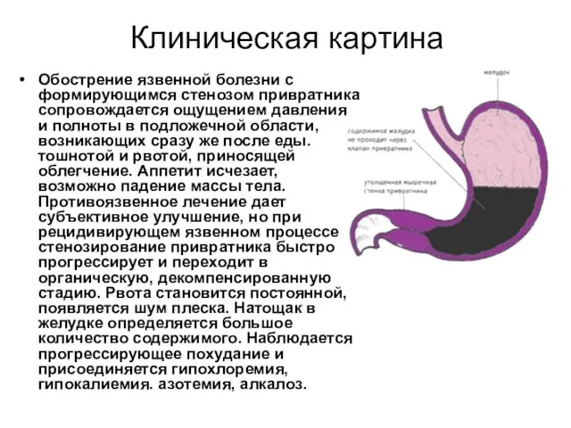 Клиническая картина Обострение язвенной болезни с формирующимся стенозом привратника сопровождается