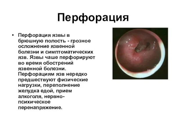 Перфорация Перфорация язвы в брюшную полость - грозное осложнение язвенной