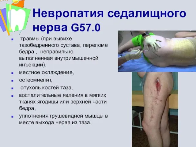 Невропатия седалищного нерва G57.0 травмы (при вывихе тазобедренного сустава, переломе