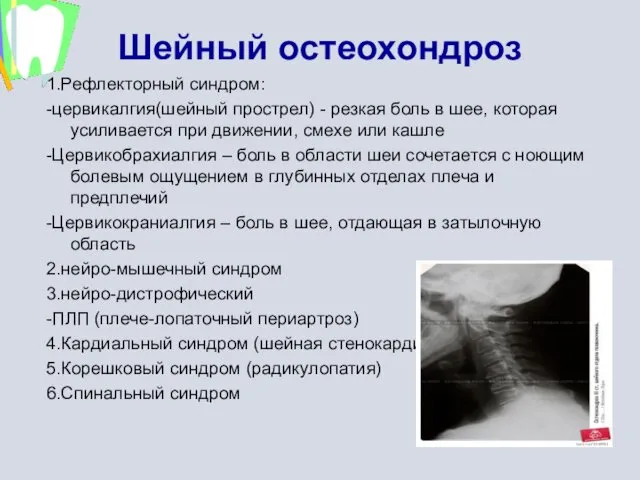 1.Рефлекторный синдром: -цервикалгия(шейный прострел) - резкая боль в шее, которая